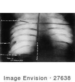 #27638 Stock Photo of an Xray Of The Bullet Inside President Theodore Roosevelt After John Schrank Shot Him On October 14th 1912 by JVPD