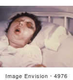 #4976 Stock Photography Of A Woman On The 5th Day Of An Anthrax Infection Involving Her Eye