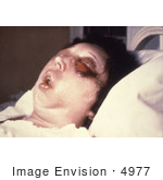 #4977 Stock Photography Of A Patient On The 5th Day Of An Anthrax Infection In Her Eye
