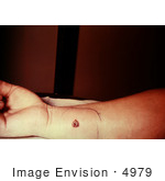 #4979 Stock Photography - 5th Day Of An Anthrax Lesion On A Woman