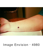 #4980 Stock Photography - 12th Day Of An Anthrax Lesion On A Woman