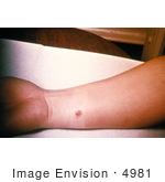 #4981 Stock Photography - 4th Day Of An Anthrax Lesion On A Woman