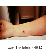 #4982 Stock Photography - 7th Day Of An Anthrax Lesion On A Woman