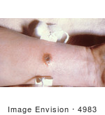 #4983 Stock Photography Of A Cutaneous Anthrax Lesion