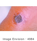 #4984 Stock Photography Of Forearm Anthrax Lesion Which Has Begun To Turn Black