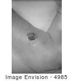 #4985 Stock Photography Of Lesion On The Left Forearm From Cutaneous Anthrax