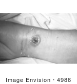 #4986 Stock Photography Of A Patients Arm With Cutaneous Anthrax Lesion