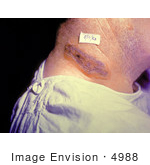 #4988 Stock Photography Of An Anthrax Neck Skin Lesion