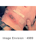 #4989 Stock Photography Of Cutaneous Anthrax Lesion
