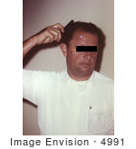 #4991 Stock Photography Of A Man With Cutaneous Anthrax Due To Bacillus Anthracis