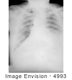 #4993 Stock Photography Of A Chest Radiograph During The 4th Day Of Anthrax Illness