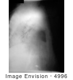 #4996 Stock Photography Of A Lateral Chest Radiograph Of Anthrax On The 13th Day