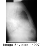 #4997 Stock Photography Of Lateral Chest Radiograph Of Anthrax On The 4th Day Of Illness