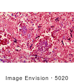 #5020 Stock Photography Of Histopathology Of Mediastinal Lymph Node In Fatal Human Anthrax