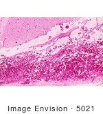 #5021 Stock Photography Of Hemorrhagic Meningitis Due To The Fatal Inhalation Anthrax