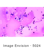 #5024 Stock Photography Of Human Meningitis With The Presence Of Bacillus Anthracis