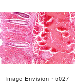 #5027 Stock Phtography - Histopathology Of Large Intestine In Fatal Human Anthrax