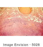 #5028 Stock Photography - Necrosis Of Lymph Node Due To Anthrax