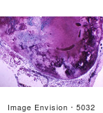 #5032 Stock Photography Of Hemorrhagic Necrosis Of A Lymph Node Due To The Anthrax Disease