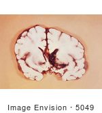 #5049 Stock Photography of a Brain Slice Revealing an Interventricular Hemorrhage by JVPD