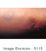 #5115 Picture Of A Patient With A Secondary Herpes Infection