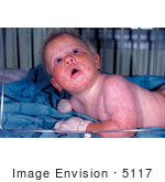 #5117 Stock Photograpy Of An 8 Month Old Infant With A Widespread Rash From A Generalized Vaccinia Reaction