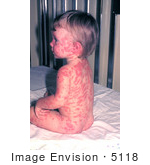 #5118 Picture Of A Child That Developed Rrythema Multiforme From A Smallpox Vaccination