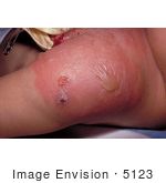 #5123 Stock Photography Of A Child That Developed A Secondary Staphylococcal Infection At The Smallpox Vaccination Site