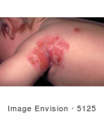 #5125 Stock Photo Of A Child With A Secondary Infection From A Smallpox Vaccination