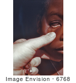 #6768 Picture Of A Cdc Eis Officer Examining The Palpebral Conjunctiva Of A Nigerian Child With Anemia Symptoms