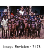 #7478 Picture Of A Nurse Standing With A Group Of African Children Showing Symptoms Of The Protein-Deficiency Disease Kwashiorkor