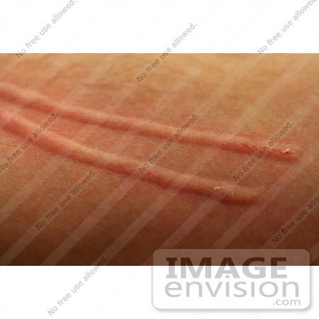 #19412 Stock Photo of a Man’s Skin on His Arm, Raised After a Cat Scratch by Jamie Voetsch
