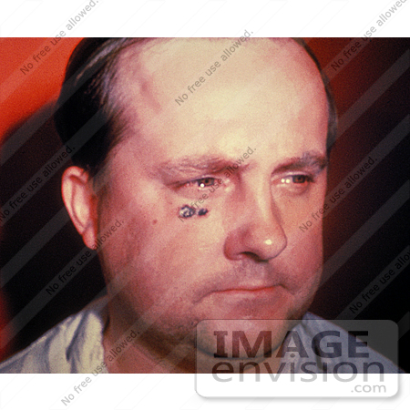 #4969 Stock Photography of a Man with a Skin Lesion from the Anthrax Disease by JVPD