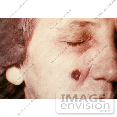 #4970 Stock Photography of an Woman with an Anthrax Skin Lesion on the 13th Day by JVPD