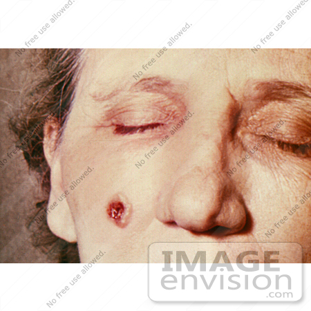 #4971 Stock Photography of an Woman with an Anthrax Skin Lesion on the 5th Day by JVPD