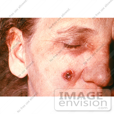#4973 Stock Photography of an Woman with an Anthrax Skin Lesion on the 11th Day by JVPD
