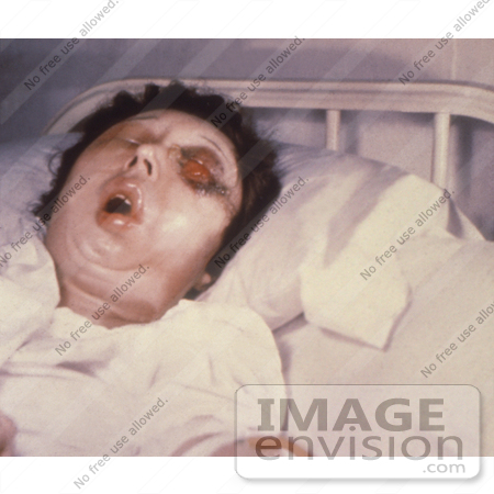 #4976 Stock Photography of a Woman On the 5th Day of an Anthrax Infection Involving Her Eye by JVPD