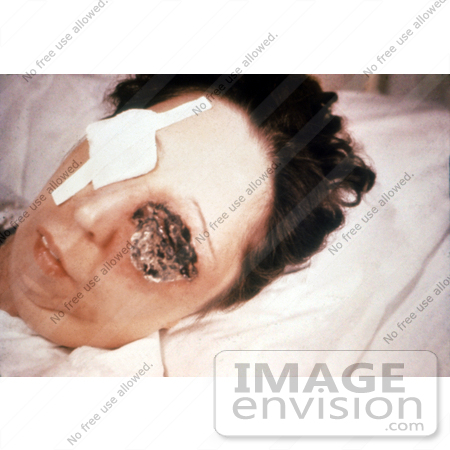 #4978 Stock Photography of a Patient On the 25th Day of an Anthrax Infection Involving Her Eye by JVPD