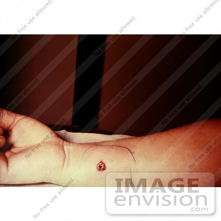 #4979 Stock Photography - 5th Day of an Anthrax Lesion on a Woman by JVPD