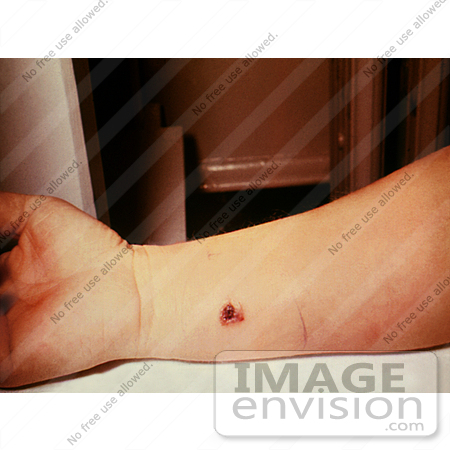 #4982 Stock Photography - 7th Day of an Anthrax Lesion on a Woman by JVPD