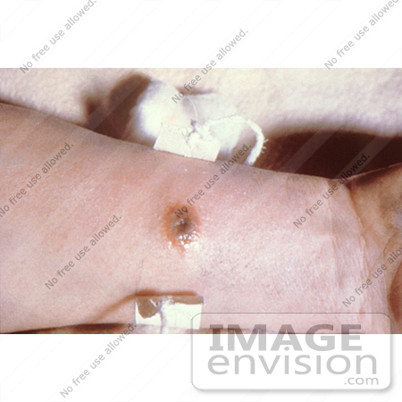 #4983 Stock Photography of a Cutaneous Anthrax Lesion by JVPD