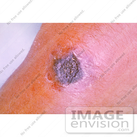 #4984 Stock Photography of Forearm Anthrax Lesion Which Has Begun to Turn Black by JVPD