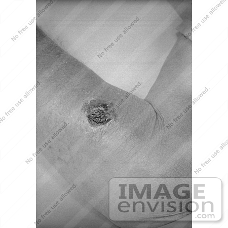 #4985 Stock Photography of Lesion on the Left Forearm from Cutaneous Anthrax by JVPD