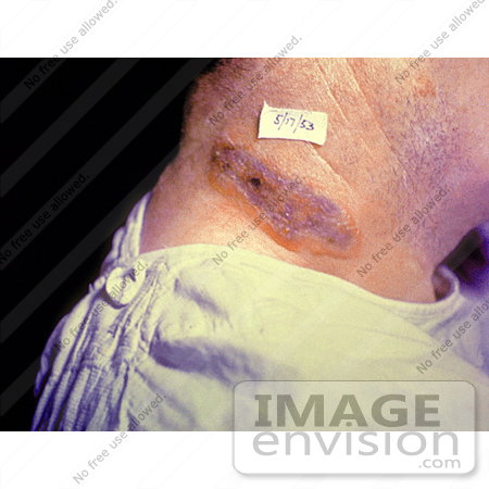 #4988 Stock Photography of an Anthrax Neck Skin Lesion by JVPD