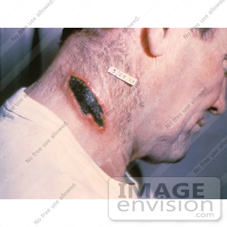 #4990 Stock Photography of a Man with a Cutaneous Anthrax Lesion On His Neck by JVPD