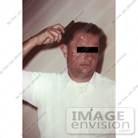 #4991 Stock Photography of a Man with Cutaneous Anthrax Due to Bacillus Anthracis by JVPD