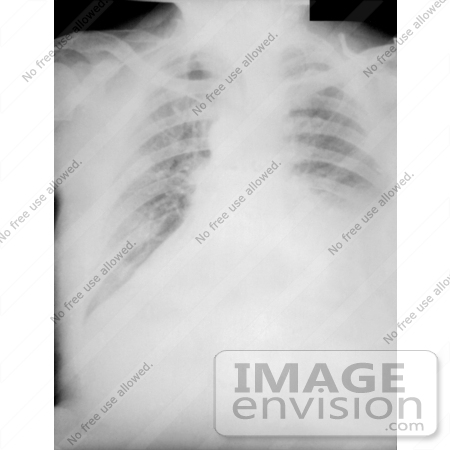 #4993 Stock Photography of a Chest Radiograph During the 4th Day of Anthrax Illness by JVPD