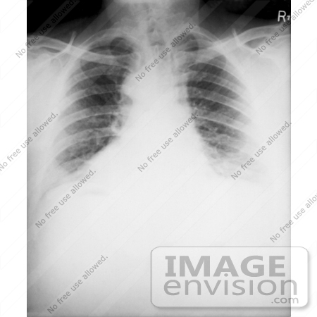 #4995 Stock Photography of the Chest X-ray of a 46 Year Old Man Diagnosed with the Anthrax Disease by JVPD