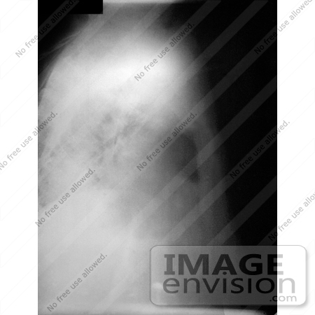 #4996 Stock Photography of a Lateral Chest Radiograph of Anthrax On the 13th Day by JVPD