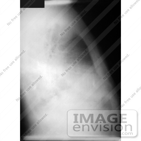 #4997 Stock Photography of Lateral Chest Radiograph of Anthrax On the 4th Day of Illness by JVPD